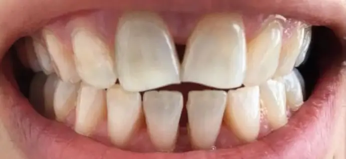 <span class="bt_bb_before_after_image_before_text">Antes</span>