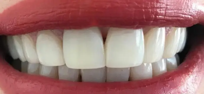<span class="bt_bb_before_after_image_after_text">Después</span>