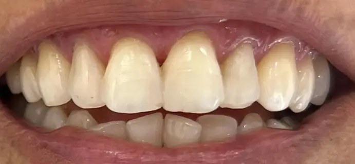 <span class="bt_bb_before_after_image_before_text">Antes</span>