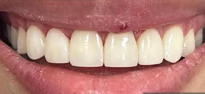<span class="bt_bb_before_after_image_after_text">Después</span>