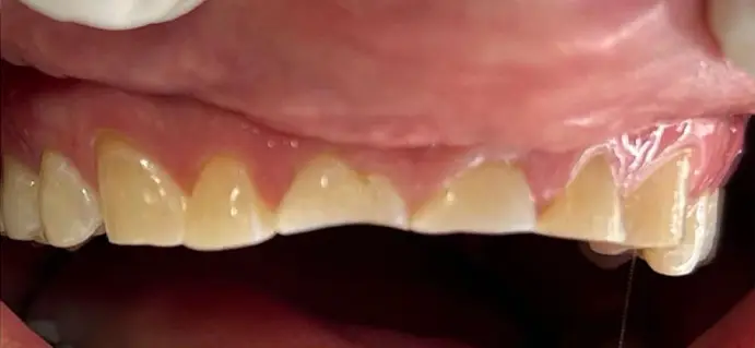 <span class="bt_bb_before_after_image_before_text">Antes</span>