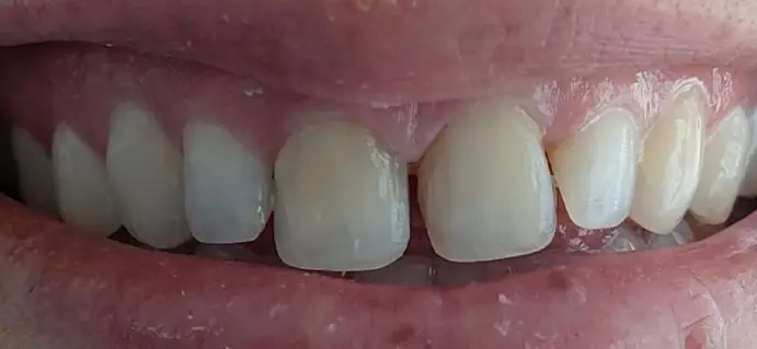 <span class="bt_bb_before_after_image_before_text">Antes</span>