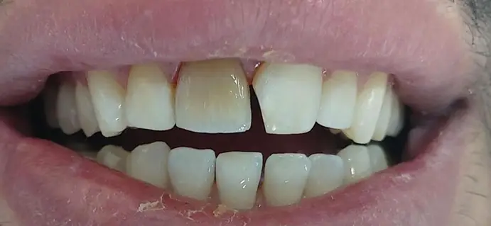 <span class="bt_bb_before_after_image_before_text">Antes</span>